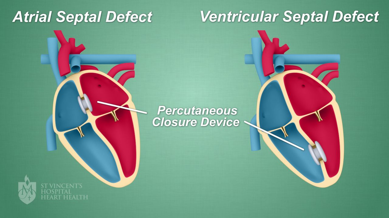 04_ASD-VSD-Closure