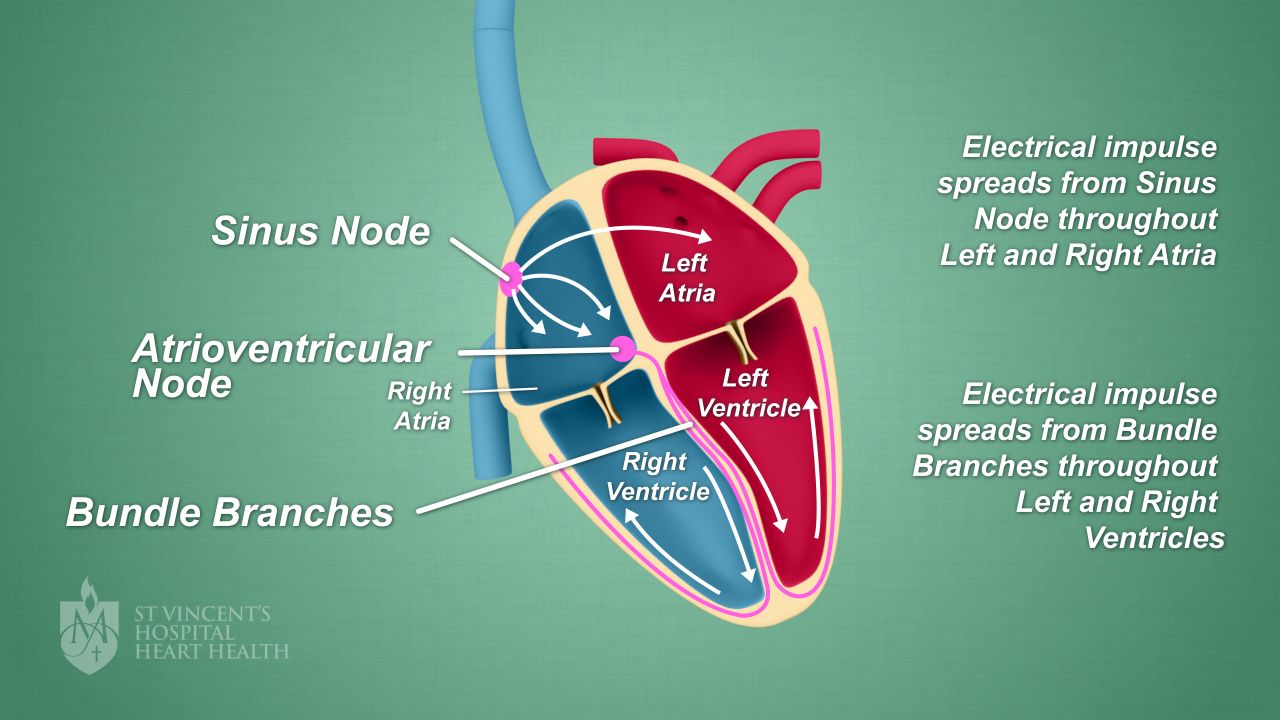 Types Of Arrhythmia Chart