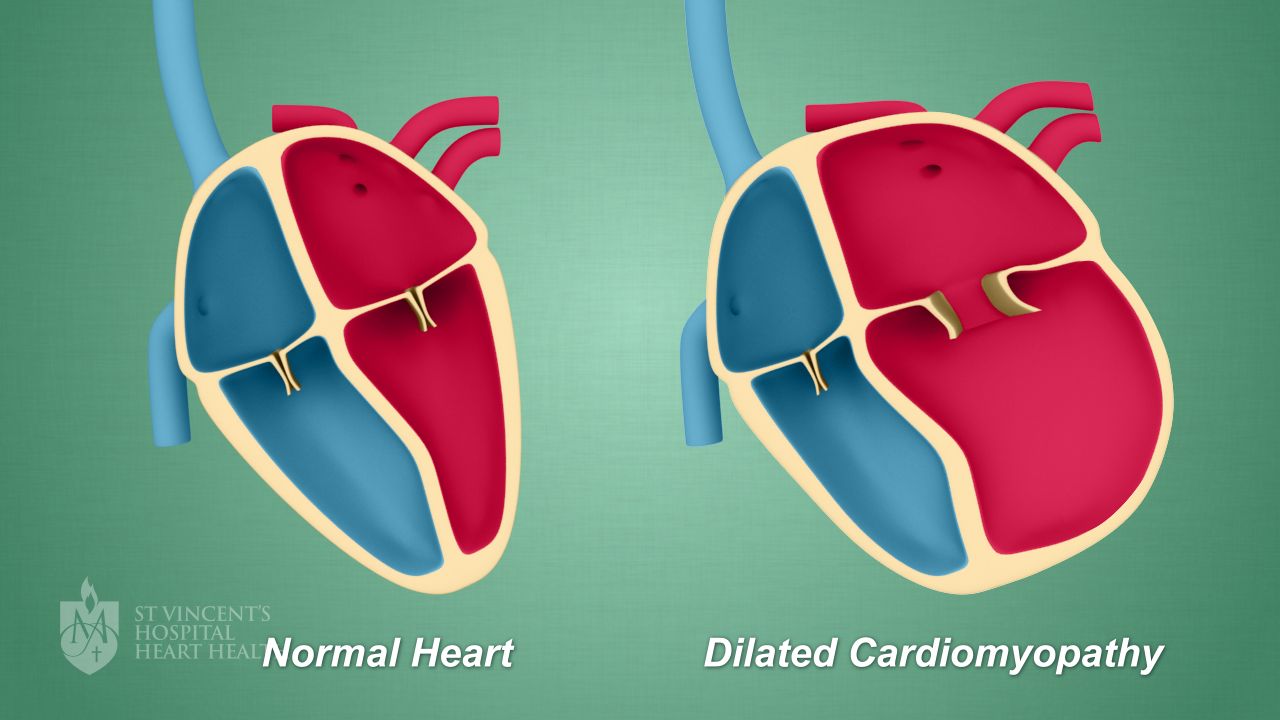 Cardiomyopathy - St Vincent's Heart Health