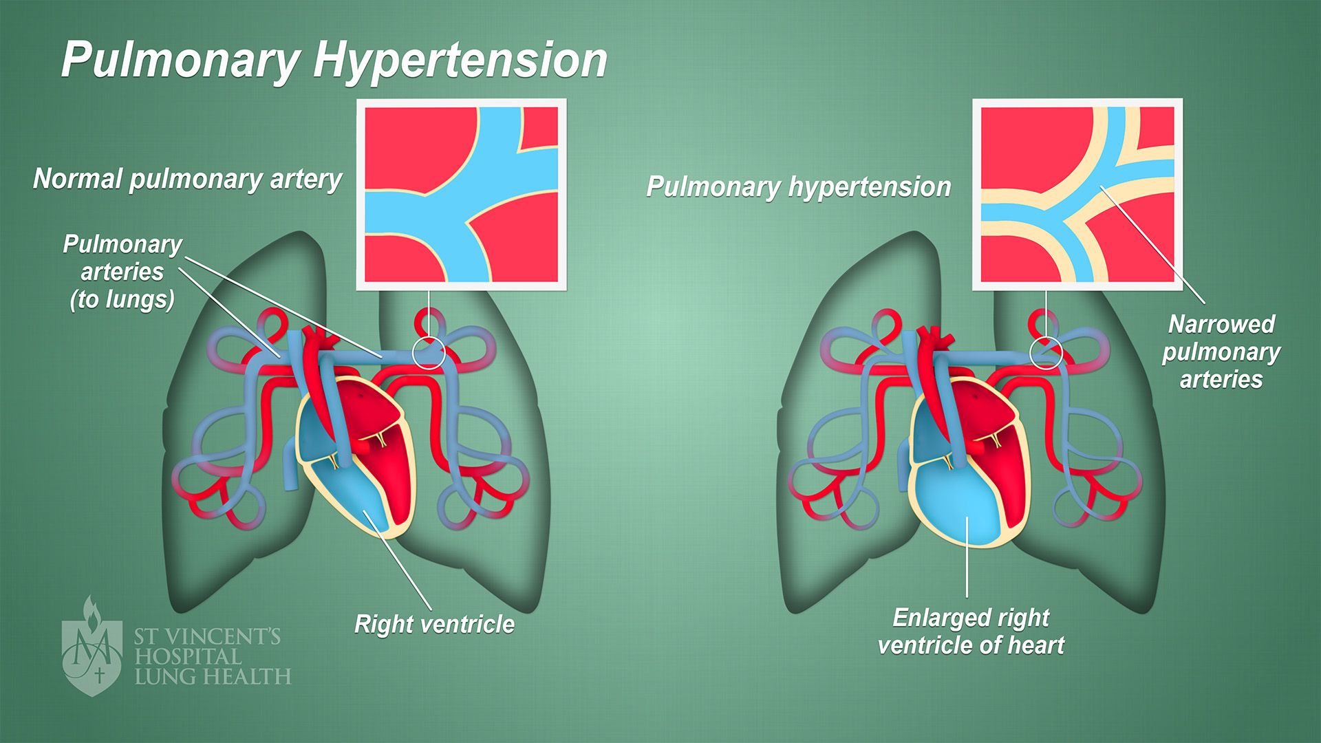 acute presentation of pulmonary hypertension