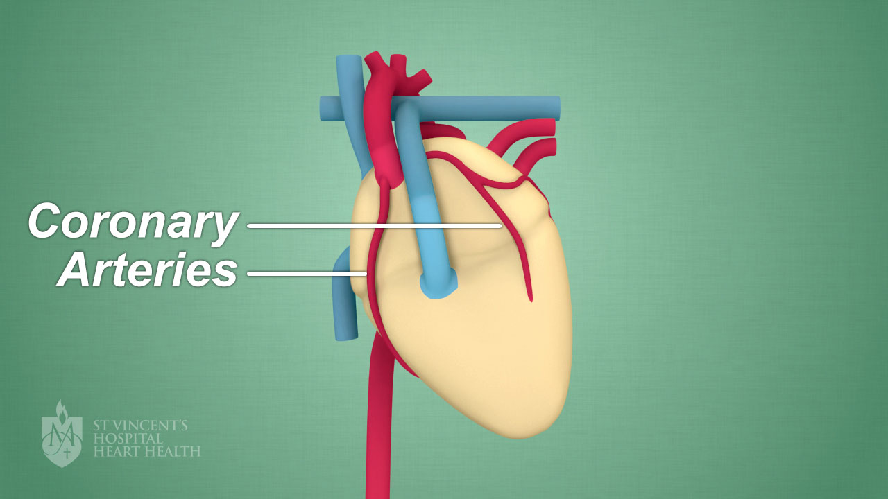 Spontaneous Coronary Artery Dissection or "SCAD" - St Vincent's Heart