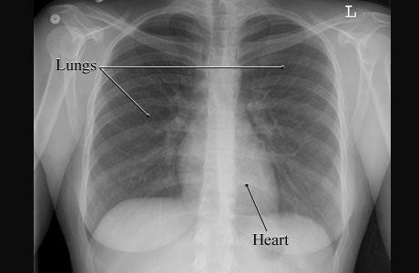 Chest X Ray St Vincent S Heart Health