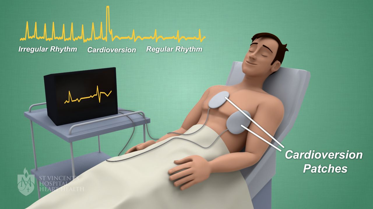 05_Cardioversion