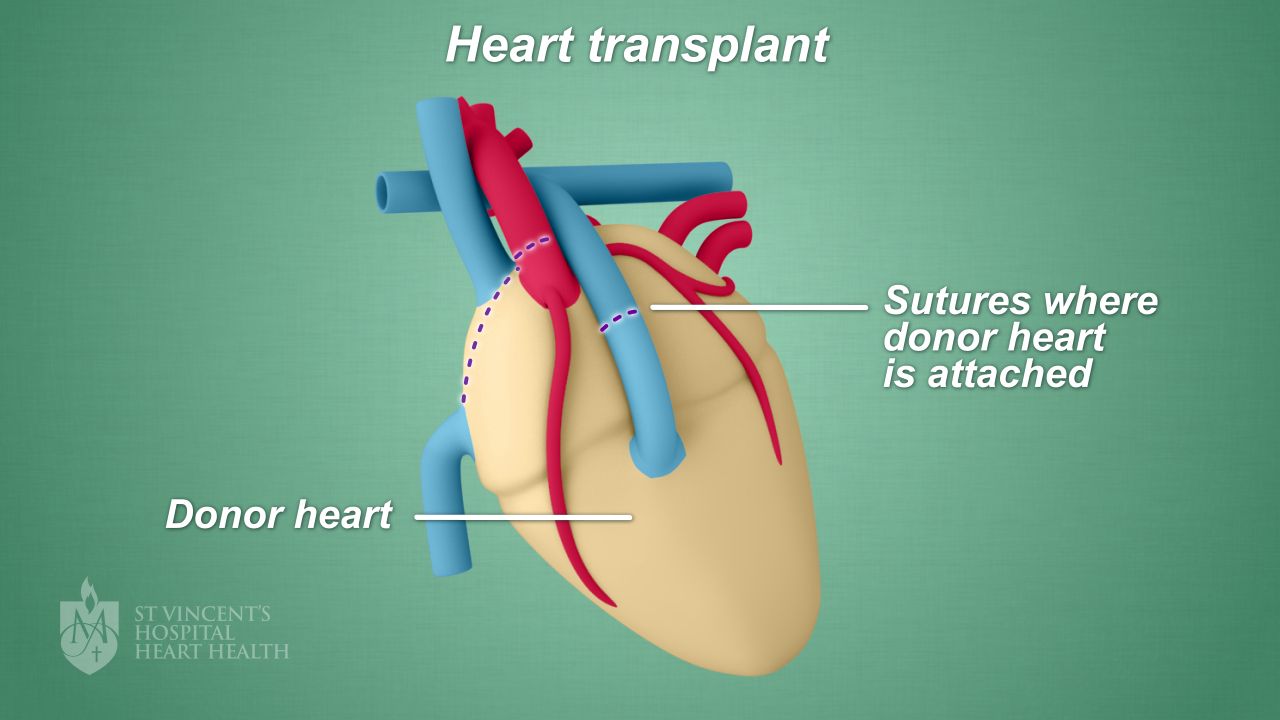 End-Stage Heart Disease and Indications for Heart Transplantation