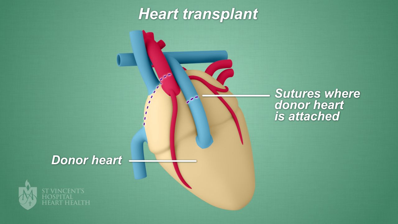 Heart Transplant St Vincent s Heart Health Heart Transplant St Vincent s Heart Health